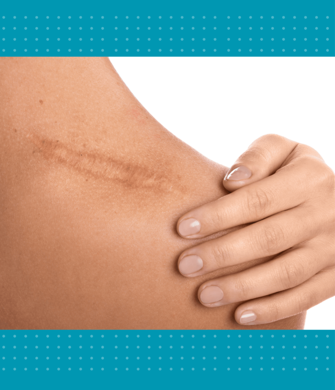 Tatuaj Vitiligo/Cicatrici